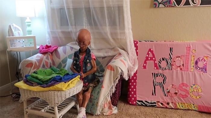 世界上很年轻的“老太太”,12岁就长成80岁模样,这是什么原