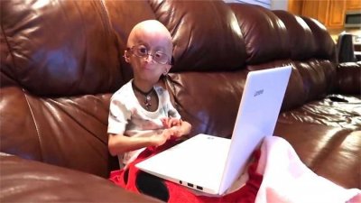 ​世界上很年轻的“老太太”，12岁就长成80岁模样，这是什么原