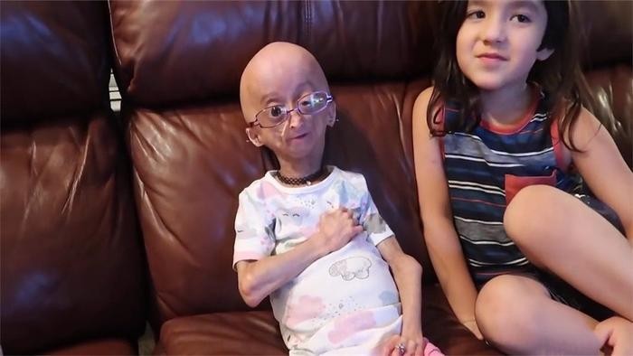 世界上很年轻的“老太太”,12岁就长成80岁模样,这是什么原