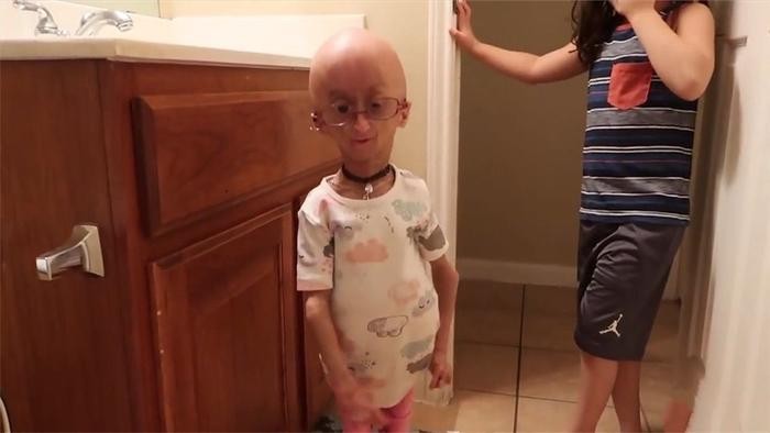 世界上很年轻的“老太太”,12岁就长成80岁模样,这是什么原