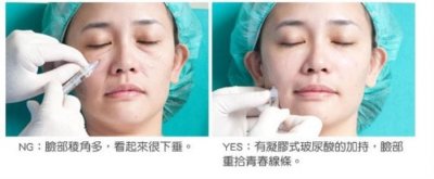 注射除皱的方法(注射除皱的危害是什么)