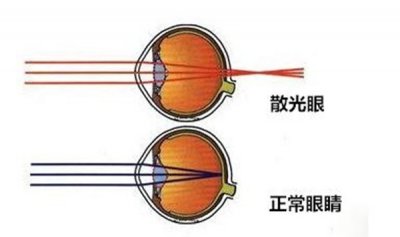 ​散光是怎样形成的 人为什么会爆发散光