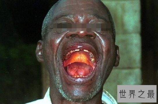 人类历史上最可怕的十大病毒，天花病毒死了1.5亿人