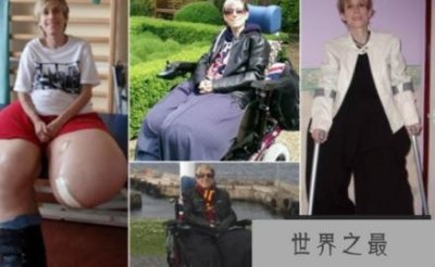​英国妇女,世界上最大和最重的腿,重达108公斤
