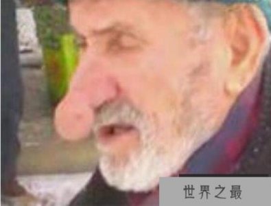 ​世界上最大的鼻子：土耳其老人鼻子长14厘米