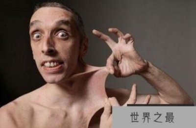 ​加里,世界上最有弹性的皮肤特纳下巴的皮肤覆盖着他的嘴