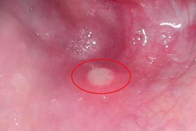 小儿疱疹性咽峡炎图片(小儿疱疹性咽峡炎吃什么药)