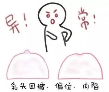 ​乳头内陷是怎么回事？医生教你分3种层次区分，女生最好看看