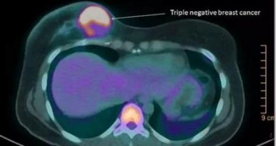 ​三阴乳腺癌真的没救吗(三阴乳腺癌有没有治好的案例)
