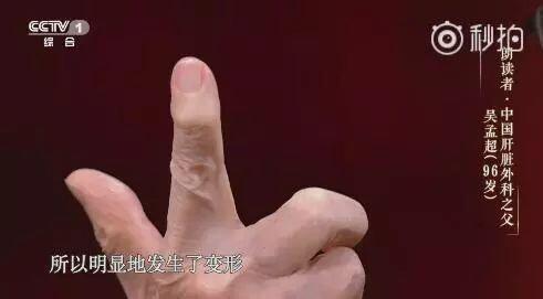 96岁“朗读者”中国肝胆外科之父，坚持每周三台手术却遗憾救不了父亲