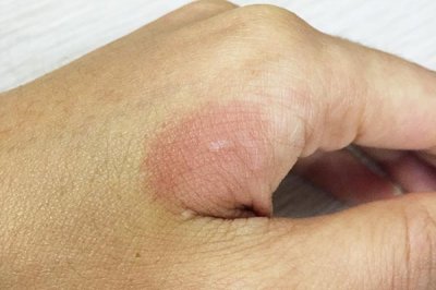 ​手被开水烫了怎么办 烫伤后该怎么做？偏方不能乱用，正确处理是关键，正确方法