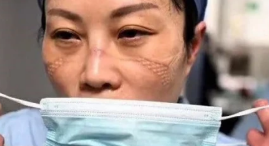 长期戴口罩对脸部的影响,长期戴口罩会变丑吗图8