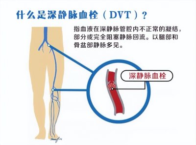 什么是深静脉血栓(DVT),有什么症状?怎么治?